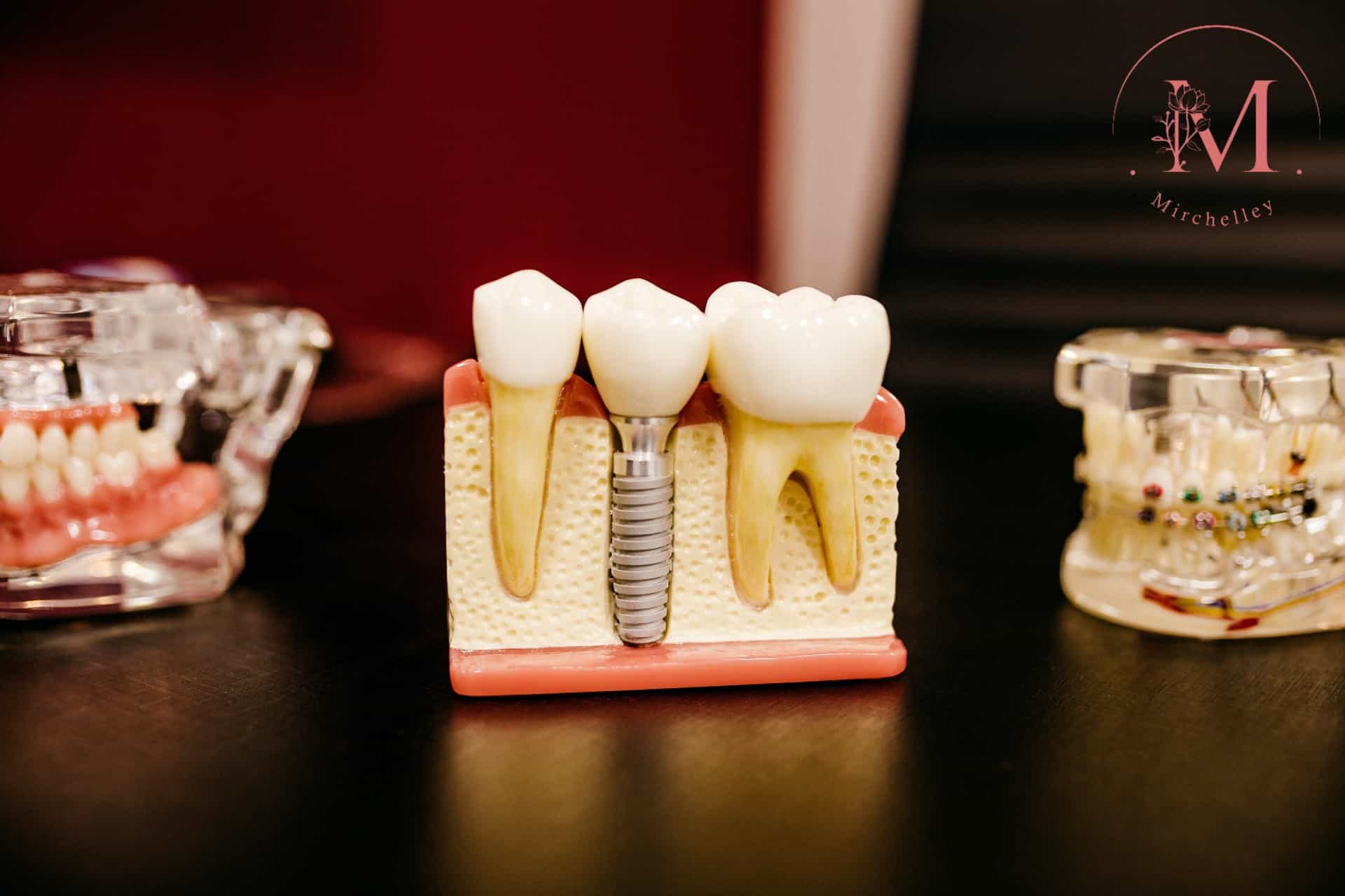 The Top 5 Clinics for Wisdom Tooth Extraction in Singapore Homepage